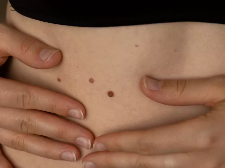 Zmiany skórne - kiedy udać się do dermatologa?