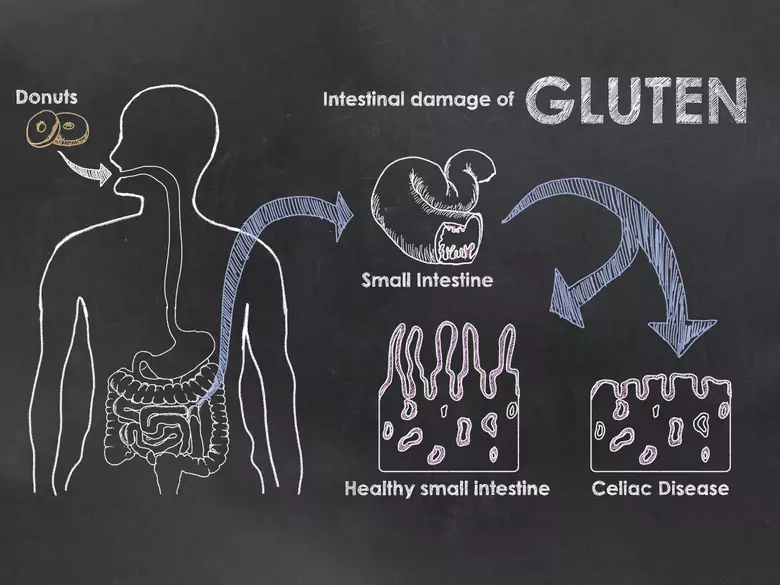 Czy żywność bezglutenowa jest zawsze zdrowsza?