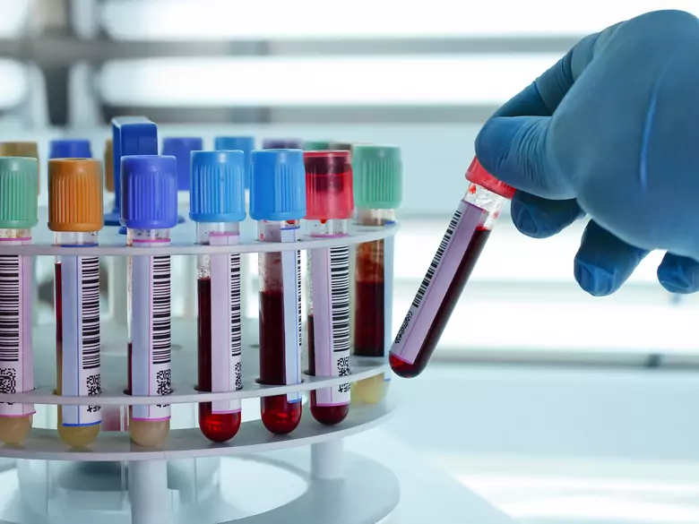 Co to jest zdrowy poziom cholesterolu?