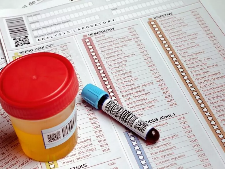 Co oznacza podwyższony poziom kwasu moczowego?