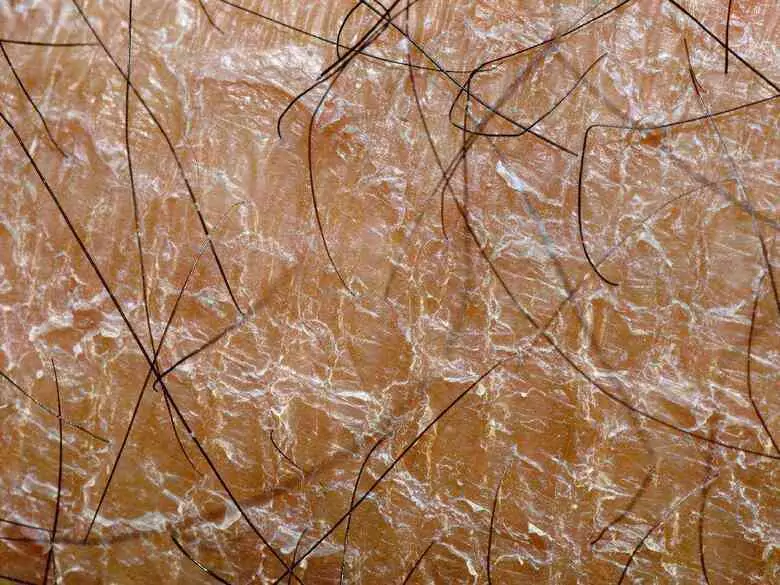 Jak radzić sobie z problemami z łojotokiem?