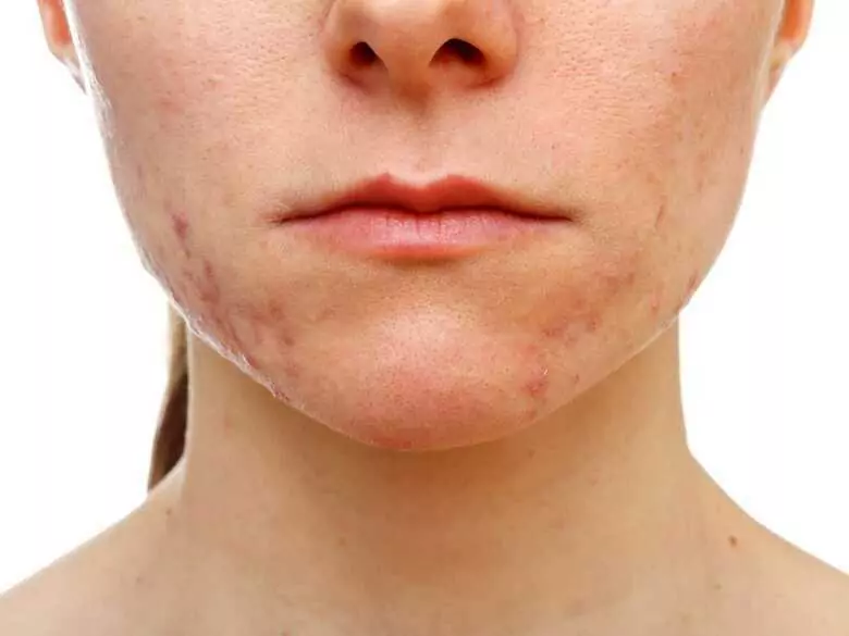 Jak radzić sobie z problemami z trądzikiem różowatym?