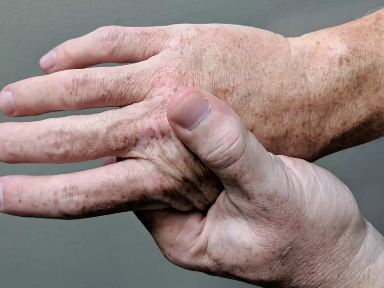 Jak radzić sobie z problemami z zapaleniem stawów?