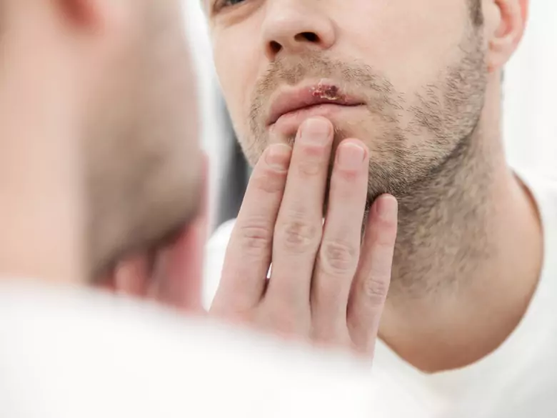 Jak leczyć opryszczkę?