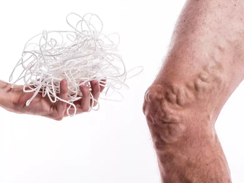 Jak leczyć żylaki?