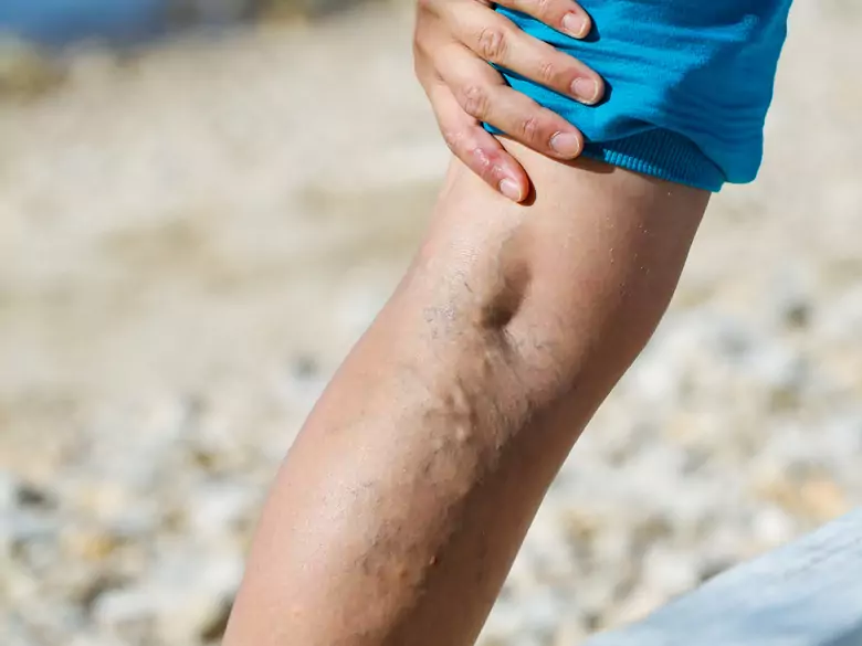 Jak radzić sobie z problemami z żylakami?